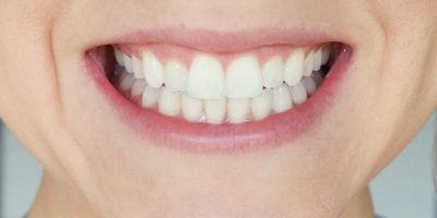 lifestyled-by-me-smile-brilliant-at-home-whitening-teeth-stains-before-1